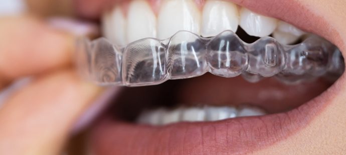 Clear Aligner Dental Night Guard